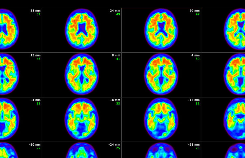  FDA Advisory Panel Endorses Approval of Alzheimer’s Drug Made by Eli Lilly