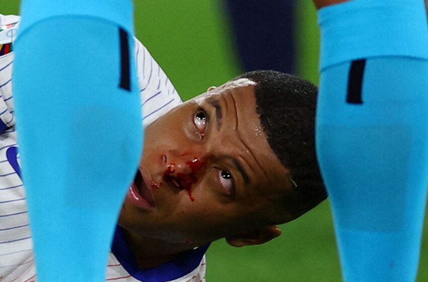  Kylian Mbappe suffers broken nose during France’s Euro 2024 opening victory