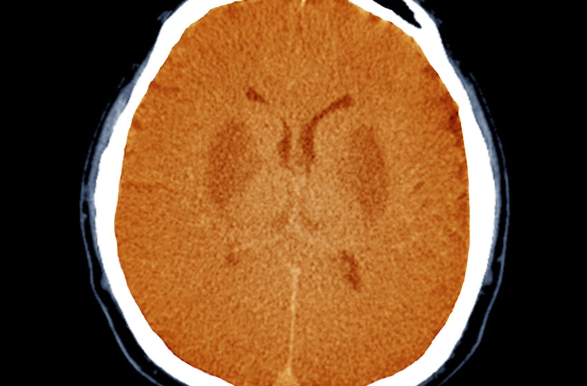  Unresponsive Brain-Damaged Patients May Have Some Awareness