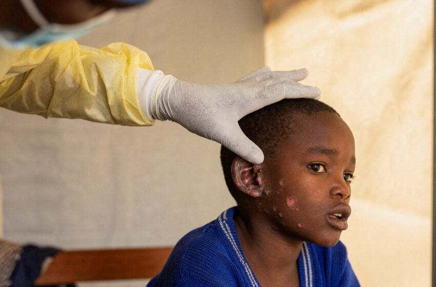  How Did Mpox Become a Global Emergency? What’s Next?