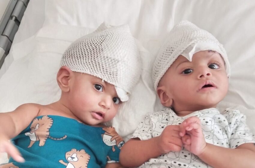 rare-conjoined-twin-girls-separated-after-14-hour-operation