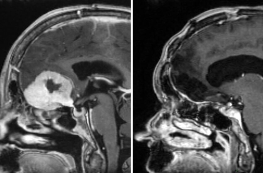  Surgeon removes brain tumours ‘the size of large apples’ through patients’ eyebrows