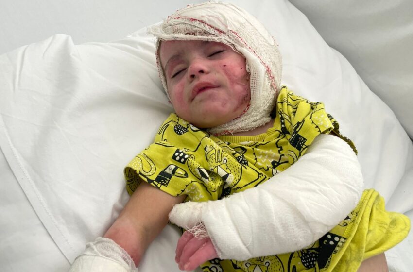 baby-suffers-burns-on-more-than-half-her-body-in-israeli-airstrike