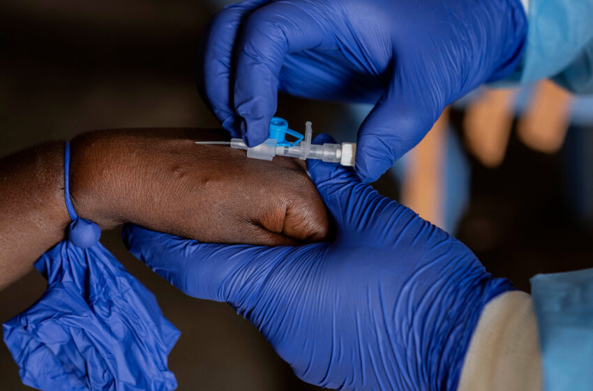  First U.S. Case of Severe Form of Mpox Reported in California