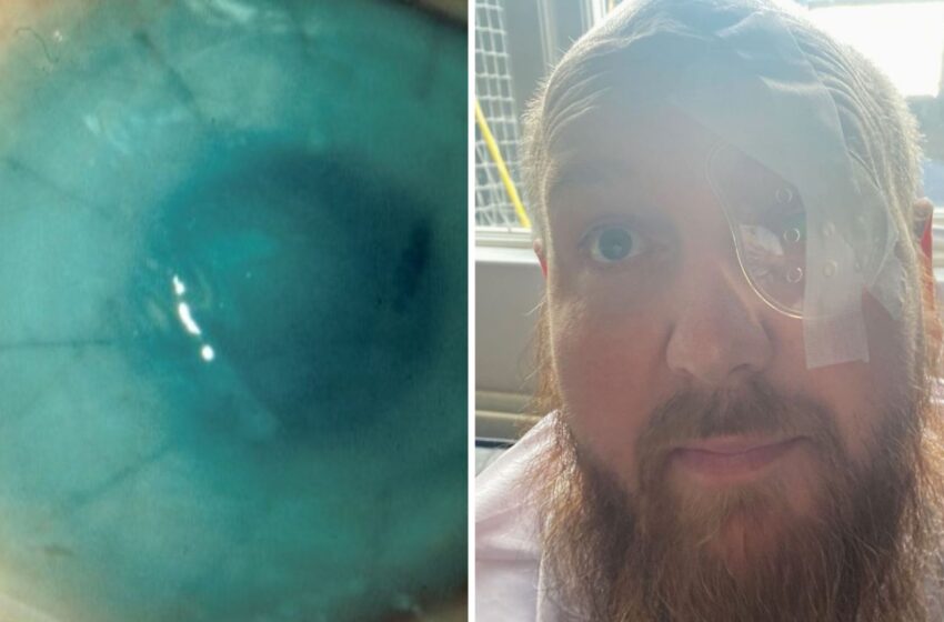  Acid attack victim reveals how donated placenta saved his eye