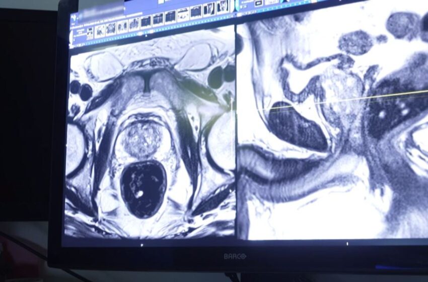  Sharp rise in prostate cancer if ‘tsunami’ of cases not detected sooner, doctor warns